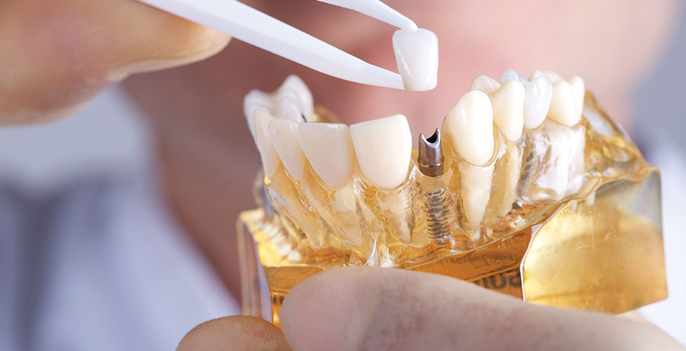 Dental Implant Model